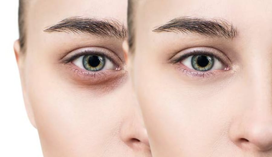 Are IIT girls afraid of dark circles?