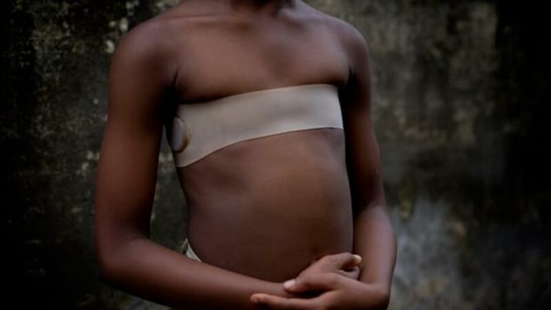 The Solution to Rape: Breast Ironing. Really?