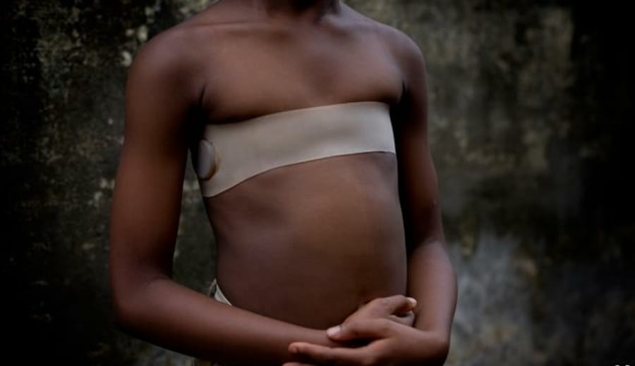 The Solution to Rape: Breast Ironing. Really?